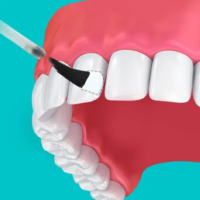 وارنیش و فلورایدتراپی دندان کودکان