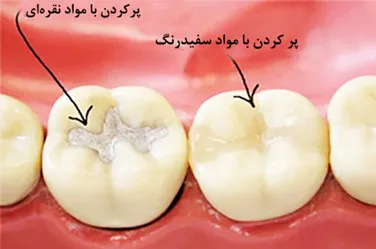 مواد پر کردن دندان کودکان