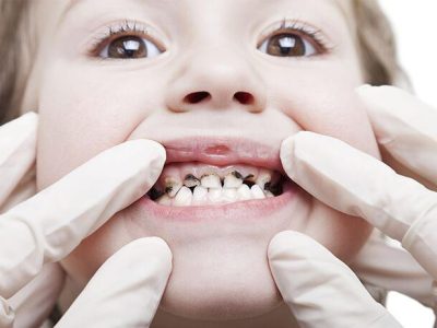 Baby tooth decay