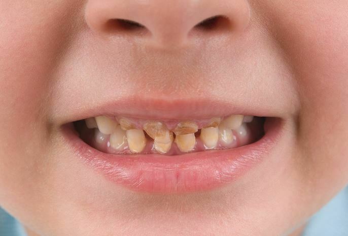 Causes of discoloration of primary and permanent teeth