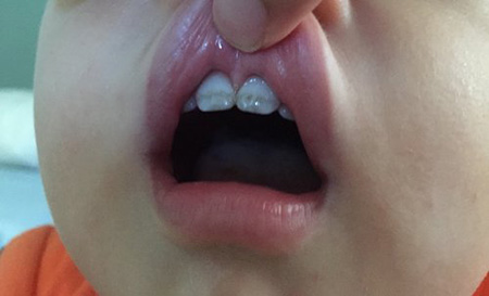 Blackening of teeth due to iron drops 1
