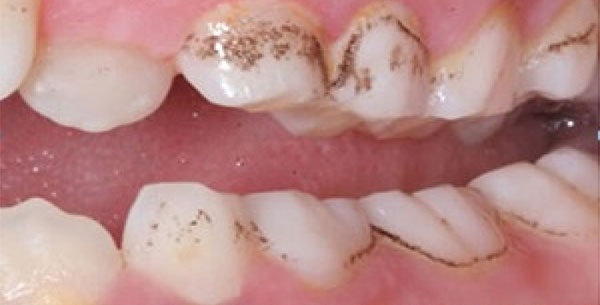 Blackening of teeth due to iron drops 3
