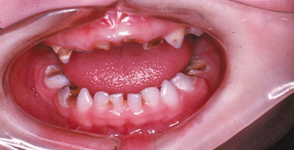 Blackening-of-teeth-due-to-iron-drops-4