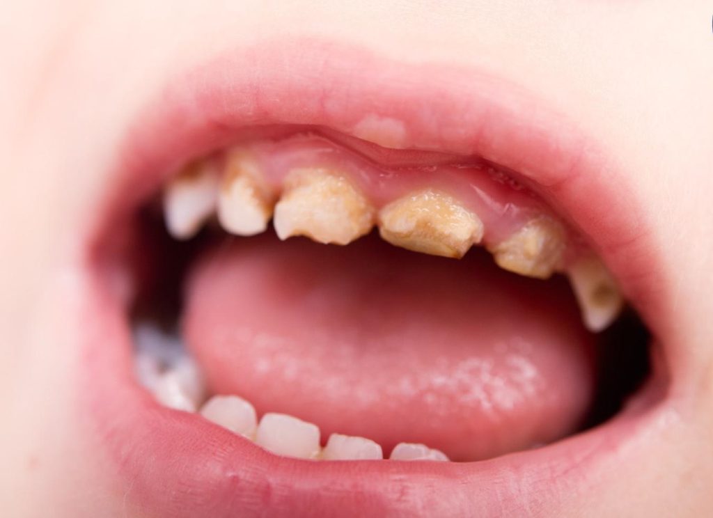 Tooth decay in children 4