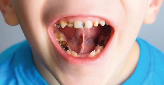 Tooth decay in children 7