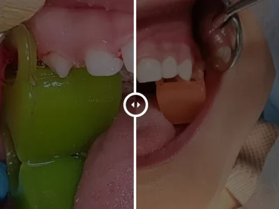 درمان دندانپزشکی کودک 22 ماهه تحت بیهوشی