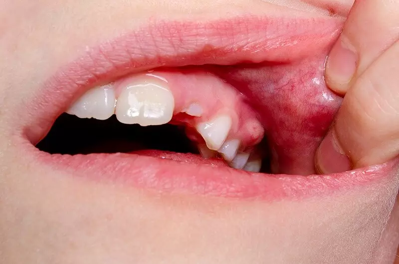 Abscess in children's teeth 1